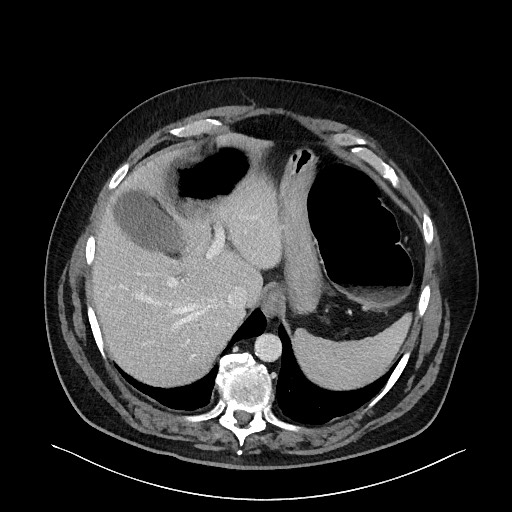 Obstructing sigmoid adenocarcinoma (Radiopaedia 58465-65619 A 32).jpg