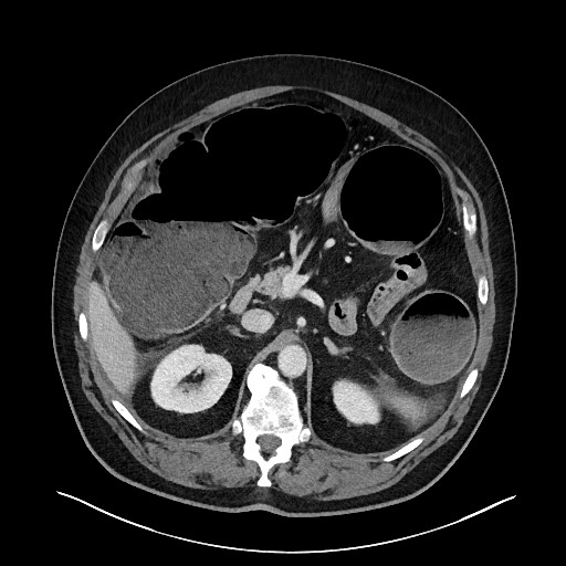 Obstructing sigmoid adenocarcinoma (Radiopaedia 58465-65619 A 54).jpg