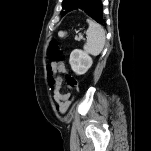 Obstructing ureteric calculus (Radiopaedia 49281-54373 C 22).jpg