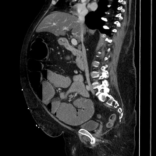 Obstructive colonic diverticular stricture (Radiopaedia 81085-94675 C 112).jpg