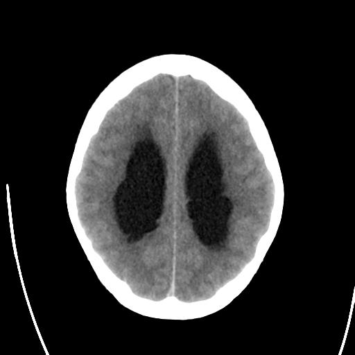 File:Obstructive hydrocephalus (Radiopaedia 30453-31119 Axial non-contrast 20).jpg