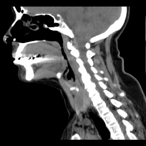 File:Obstructive sleep apnea (CT evaluation) (Radiopaedia 24304-24582 C 34).jpg