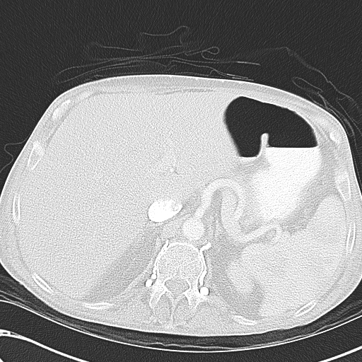 File:Obstructive superior vena cava tumor thrombus (Radiopaedia 28046-28306 Axial lung window 55).jpg