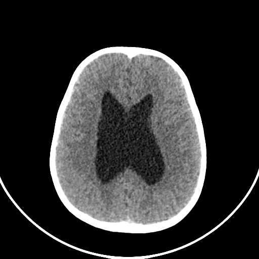 Occipital encephalocele (Radiopaedia 87339-103636 Axial non-contrast 55).jpg