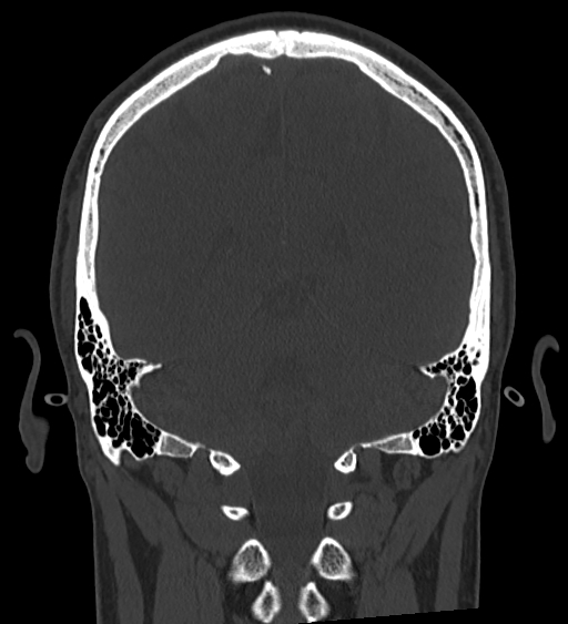 Occipital spur and Currarino type A atlas anomaly (Radiopaedia 87027-103285 Coronal bone window 102).jpg
