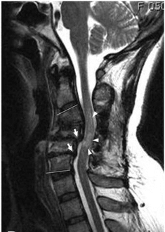 MRI shows retrolisthesis arrows ( and signal change at C3-C5 arrow heads)