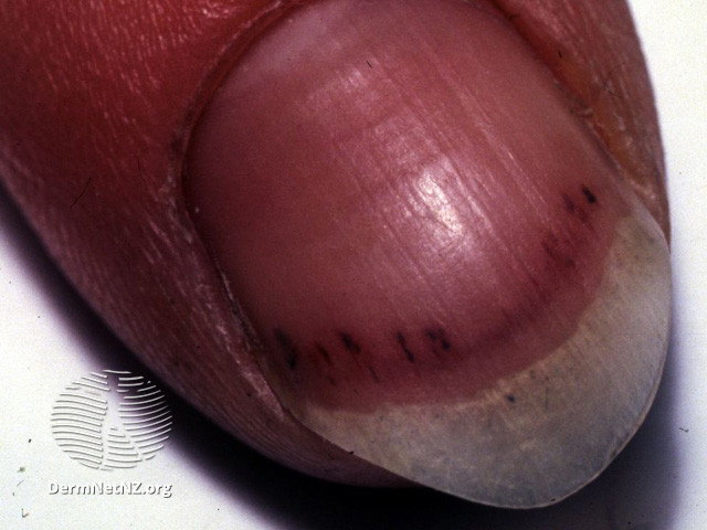 File:Splinter haemorrhages (DermNet NZ vascular-splinter).jpg