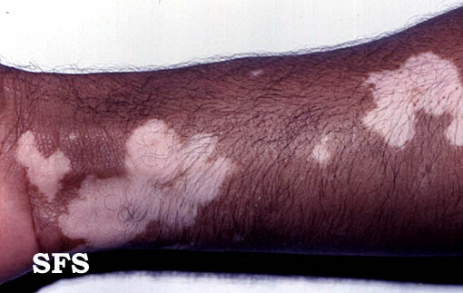 File:Vitiligo (Dermatology Atlas 5).jpg
