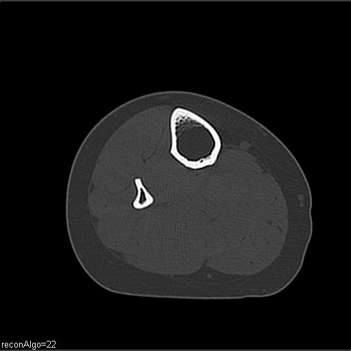 File:ACL avulsion fracture (Radiopaedia 33833-34994 Axial bone window 36).jpg
