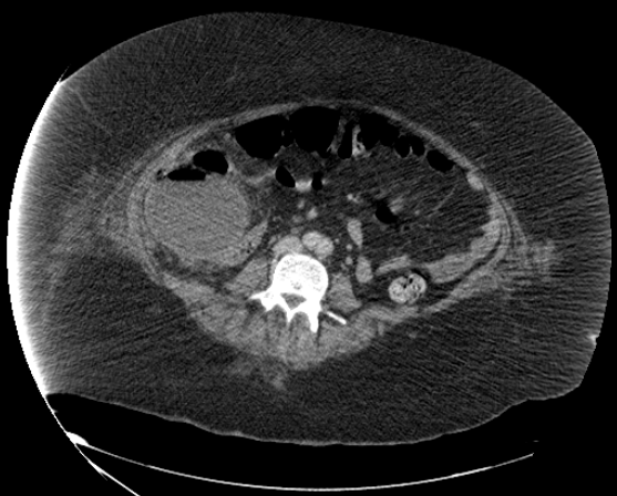 File:Abdominal abscess - pre and post percutaneous drainage (Radiopaedia 60209-67816 Axial 26).png