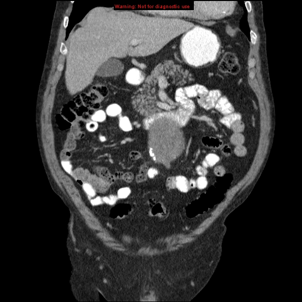 File:Abdominal aortic aneurysm (Radiopaedia 10122-10660 Coronal C+ portal venous phase 6).jpg