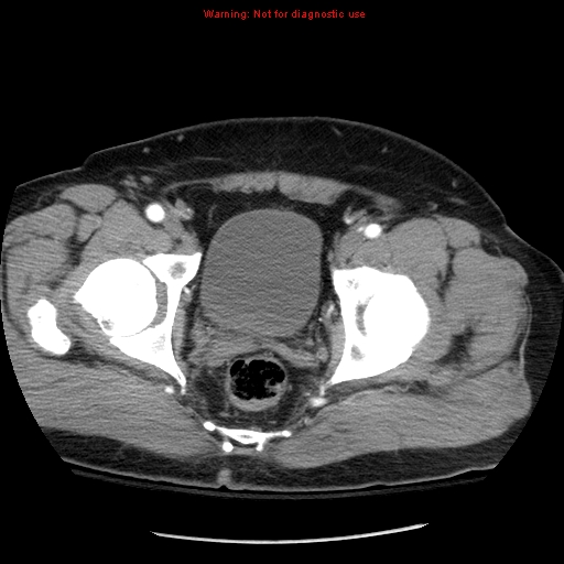 Abdominal aortic aneurysm (Radiopaedia 8190-9038 Axial C+ arterial phase 78).jpg