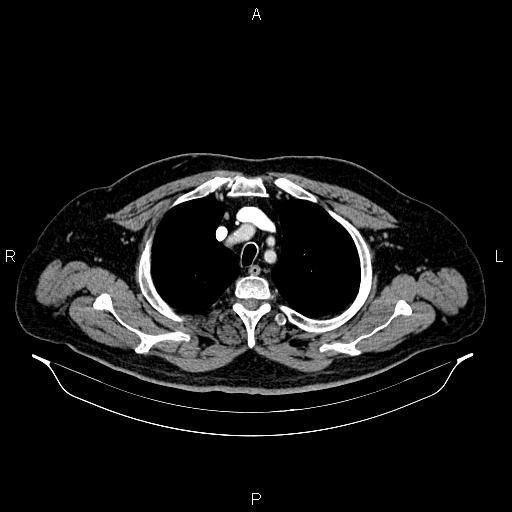 Abdominal aortic aneurysm (Radiopaedia 83094-97462 Axial renal cortical phase 16).jpg