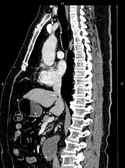 Abdominal aortic aneurysm (Radiopaedia 83094-97462 Sagittal renal cortical phase 60).jpg
