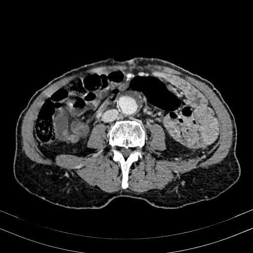 Abdominal aortic aneurysm (Radiopaedia 83581-98689 Axial C+ portal venous phase 64).jpg