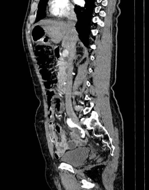 Abdominal aortic aneurysm (Radiopaedia 83581-98689 Sagittal C+ arterial phase 24).jpg