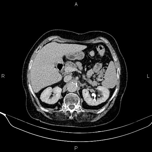 Abdominal aortic aneurysm (Radiopaedia 85063-100606 Axial C+ delayed 24).jpg