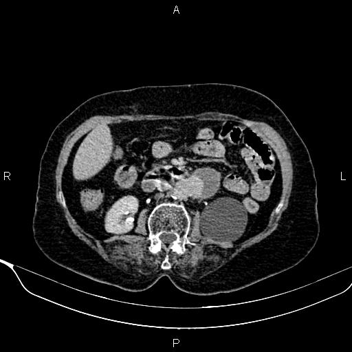 Abdominal aortic aneurysm (Radiopaedia 85063-100606 Axial C+ delayed 48).jpg