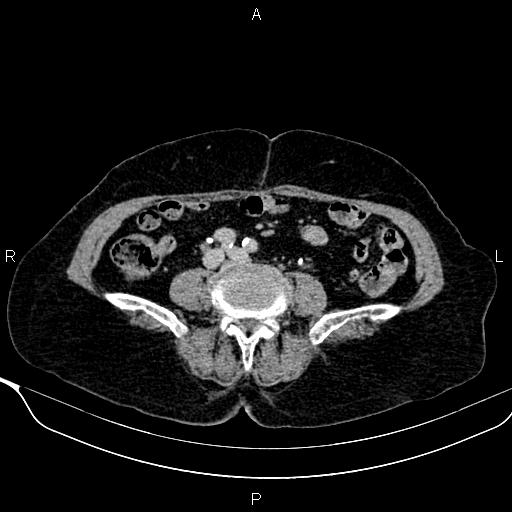 Abdominal aortic aneurysm (Radiopaedia 85063-100606 Axial C+ delayed 87).jpg