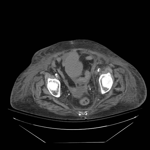 Abdominal aortic aneurysm - impending rupture (Radiopaedia 19233-19247 Axial non-contrast 146).jpg