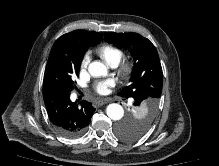 Abdominal aortic aneurysm rupture (Radiopaedia 54179-60362 Axial C+ arterial phase 11).jpg