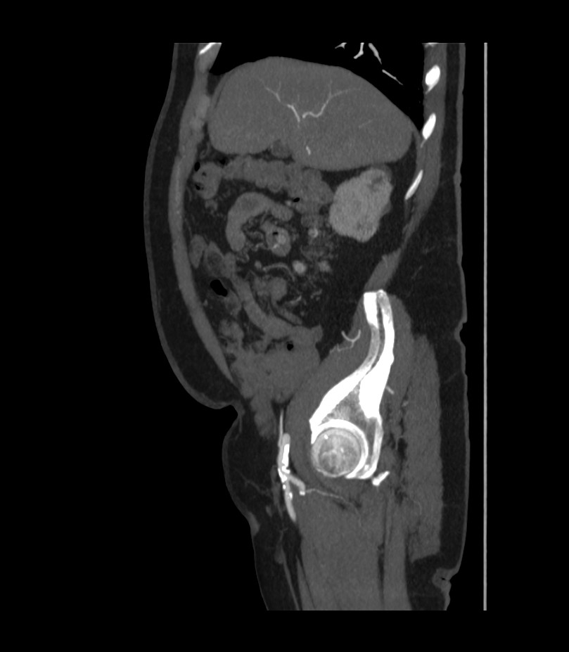 Abdominal aortic aneurysm with thrombus fissuration (Radiopaedia 46218-50618 Sagittal C+ arterial phase 14).jpg