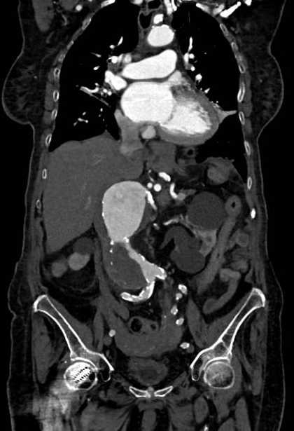 Abdominal aortic aneurysm with thrombus fissuration (Radiopaedia 73192-83919 Coronal C+ arterial phase 37).jpg