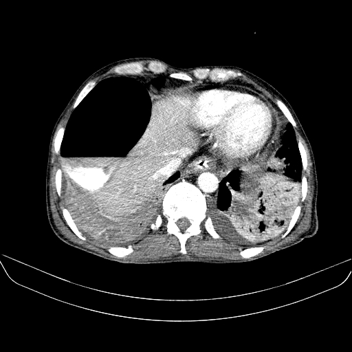 File:Abdominal collection due to previous cecal perforation (Radiopaedia 80831-94320 Axial C+ portal venous phase 22).jpg