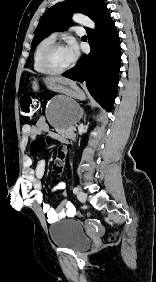 Abdominal hydatid disease (Radiopaedia 68223-77737 Sagittal C+ portal venous phase 29).jpg