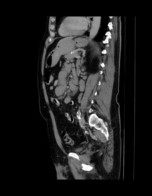Abdominal lymphoma - with sandwich sign (Radiopaedia 53486-59492 Sagittal C+ portal venous phase 31).jpg