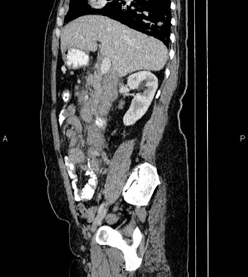 Abdominal lymphoma with sandwich sign (Radiopaedia 84378-99704 Sagittal C+ portal venous phase 29).jpg