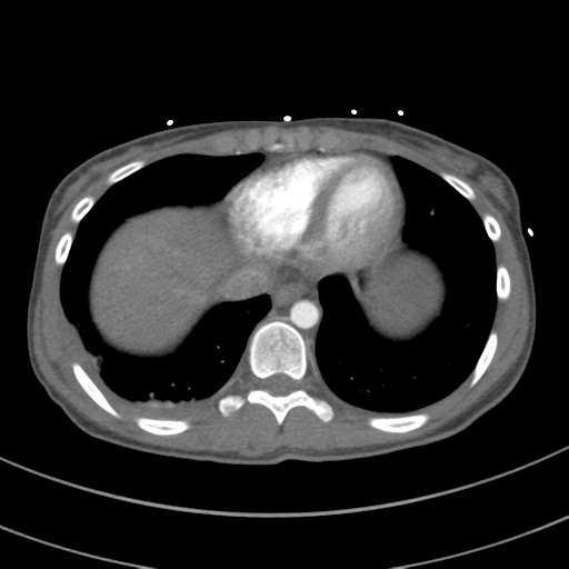 File:Abdominal multi-trauma - devascularised kidney and liver, spleen and pancreatic lacerations (Radiopaedia 34984-36486 Axial C+ arterial phase 66).png