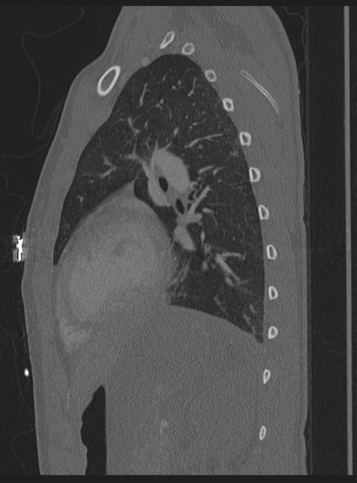 Abdominal multi-trauma - devascularised kidney and liver, spleen and pancreatic lacerations (Radiopaedia 34984-36486 Sagittal bone window 7).png