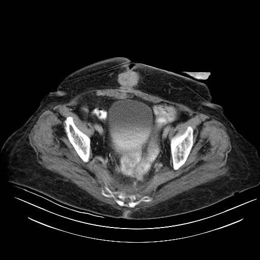 File:Abdominal wall recurrence after colorectal resection for cancer (Radiopaedia 23444-23523 Axial C+ portal venous phase 33).jpg