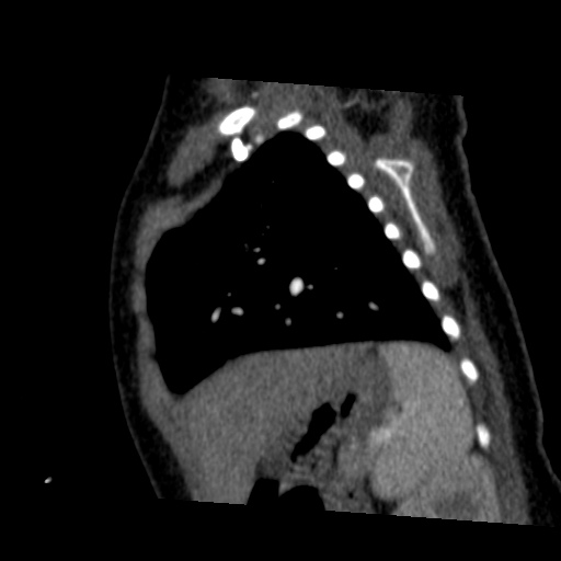Aberrant left pulmonary artery (pulmonary sling) (Radiopaedia 42323-45435 Sagittal C+ arterial phase 42).jpg