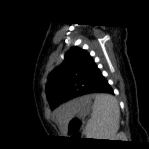 File:Aberrant left pulmonary artery (pulmonary sling) (Radiopaedia 42323-45435 Sagittal C+ arterial phase 47).jpg