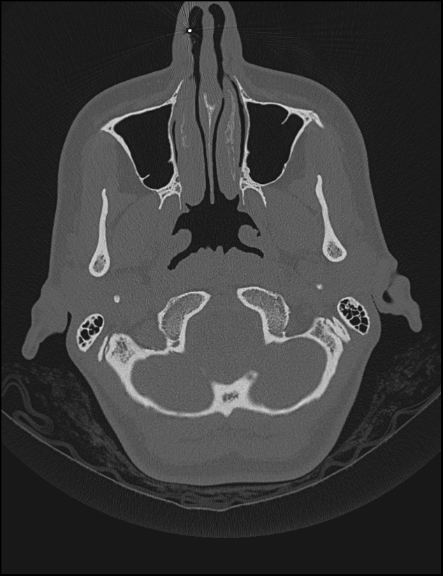 Aberrant right internal carotid artery (Radiopaedia 65191-74198 Axial non-contrast 12).jpg
