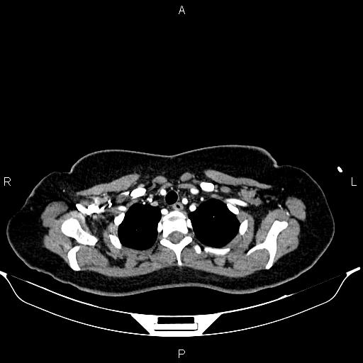 Aberrant right subclavian artery (Radiopaedia 87334-103629 Axial C+ arterial phase 12).jpg