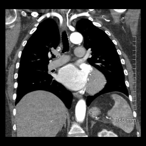 Aberrant right subclavian artery stenosis (Radiopaedia 52656-58670 B 50).jpg