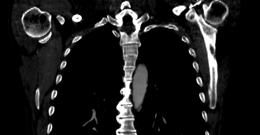 Accesory rib joint (Radiopaedia 71987-82452 Coronal bone window 25).jpg