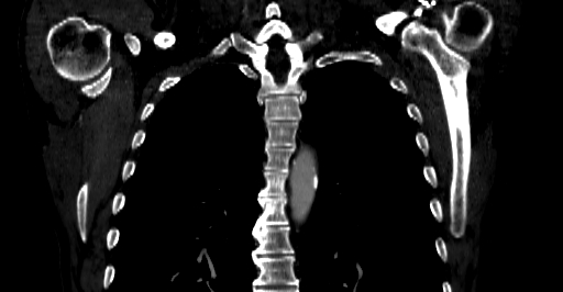 Accesory rib joint (Radiopaedia 71987-82452 Coronal bone window 28).jpg