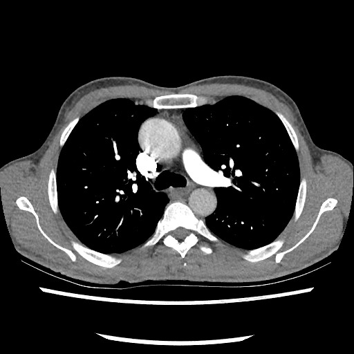 Accessory left horizontal fissure with lingular pneumonia (Radiopaedia 53763-59843 Axial C+ CTPA 37).jpg