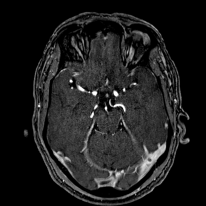Accessory middle cerebral artery (Radiopaedia 73114-83828 Axial MRA 68).jpg