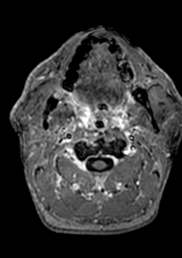 Accessory middle cerebral artery (Radiopaedia 73114-83828 Axial T1 C+ 247).jpg