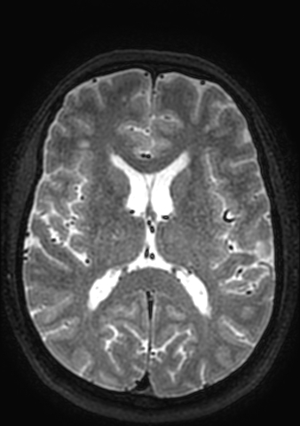 Accessory middle cerebral artery (Radiopaedia 73114-83828 Axial T2 52).jpg