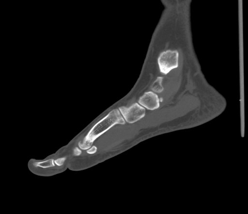 File:Accessory navicular bone (Radiopaedia 54999-61314 Sagittal non-contrast 35).jpg
