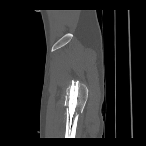 Acetabular and ilial fractures (Radiopaedia 59084-66378 Sagittal bone window 93).jpg