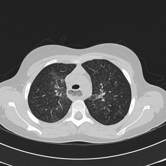 Achalasia (Radiopaedia 14946-14878 Axial lung window 19).jpg