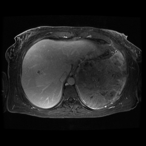 Acinar cell carcinoma of the pancreas (Radiopaedia 75442-86668 D 114).jpg