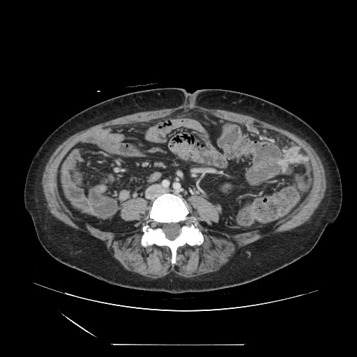 Acinar cell carcinoma of the pancreas (Radiopaedia 75442-86669 Axial C+ portal venous phase 90).jpg